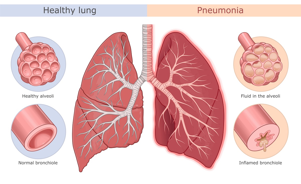Pneumónia: zdravé pľúca a zapálené pľúca s infiltrátom v alveolách